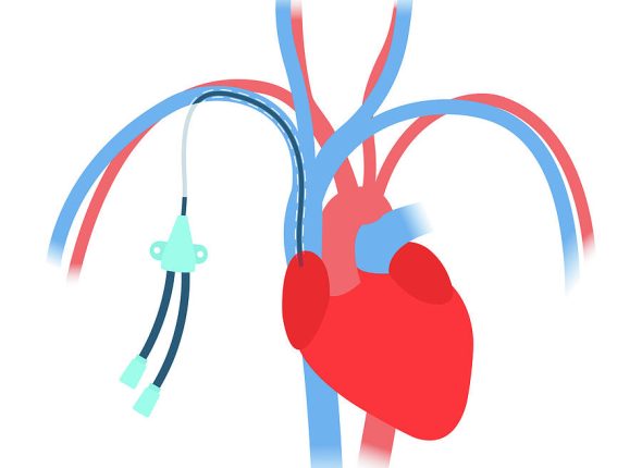 central-venous-catheter-art4stockscience-photo-library